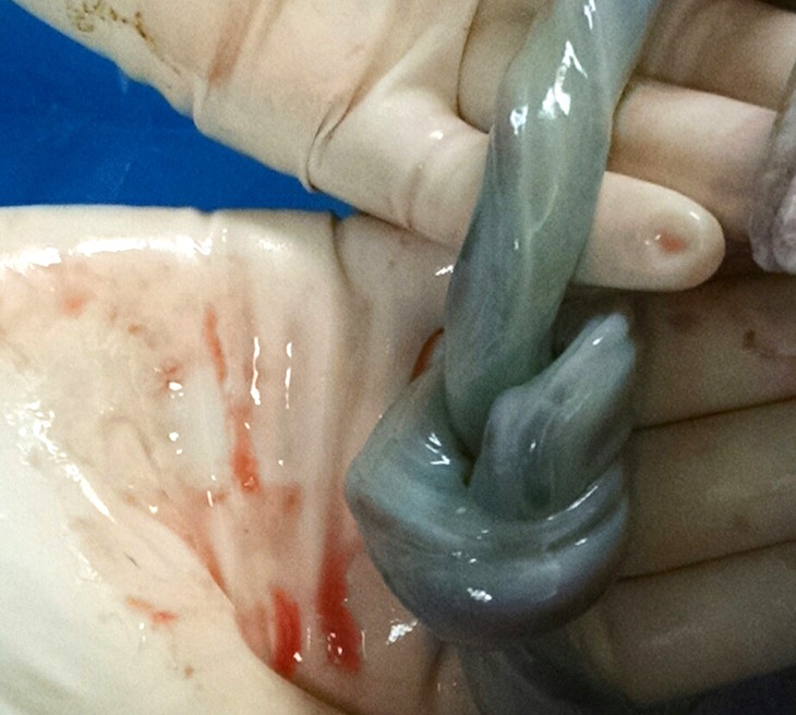umbilical cord in a knot