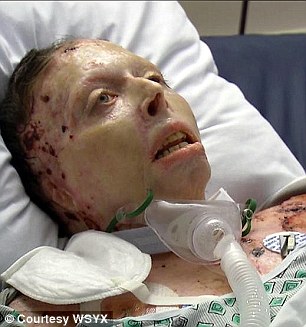 woman set on fire