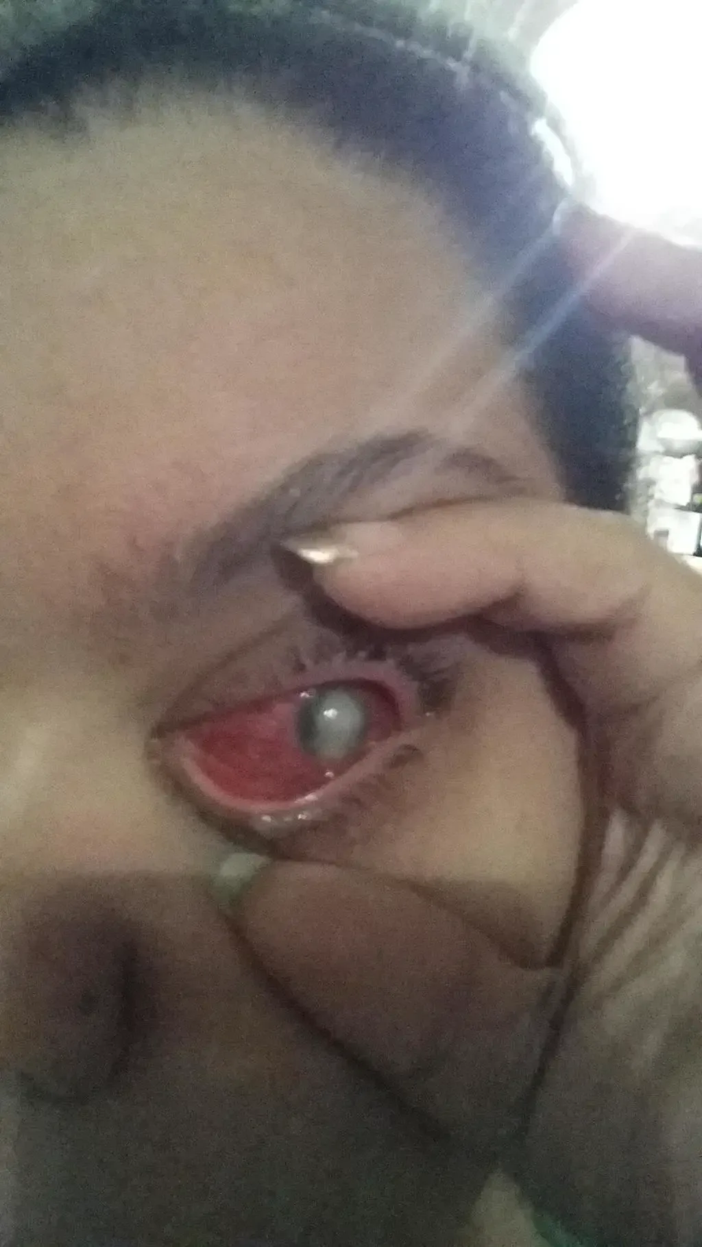 eye removal