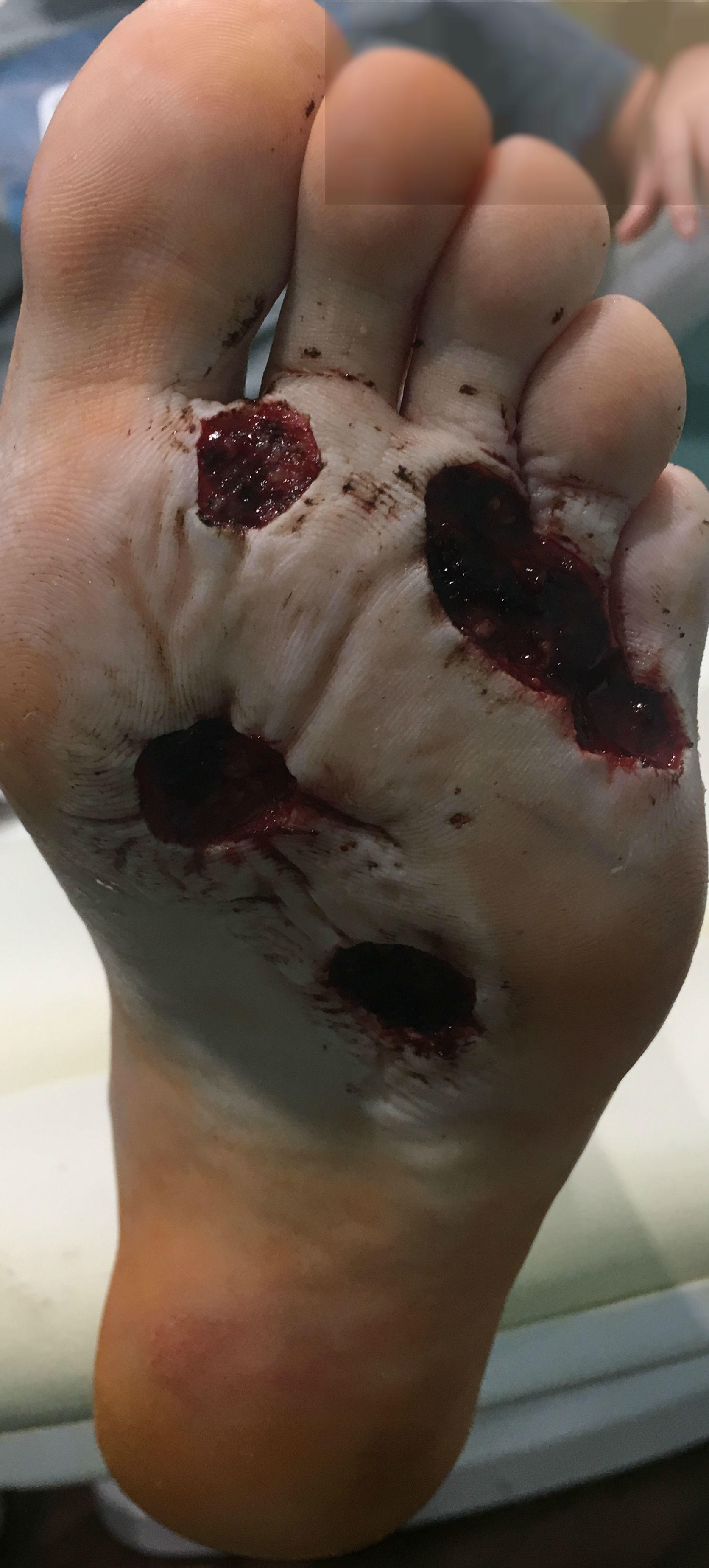 foot blisters