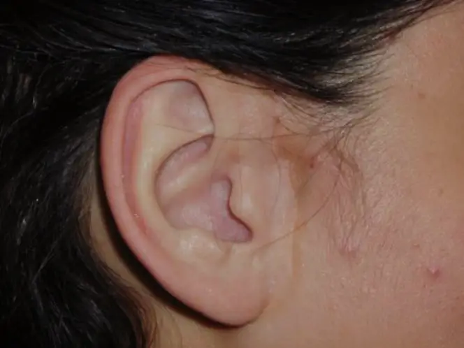 ants in the ear