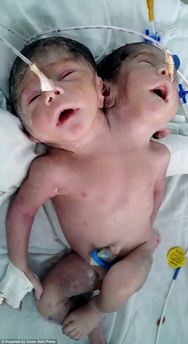 two-headed baby