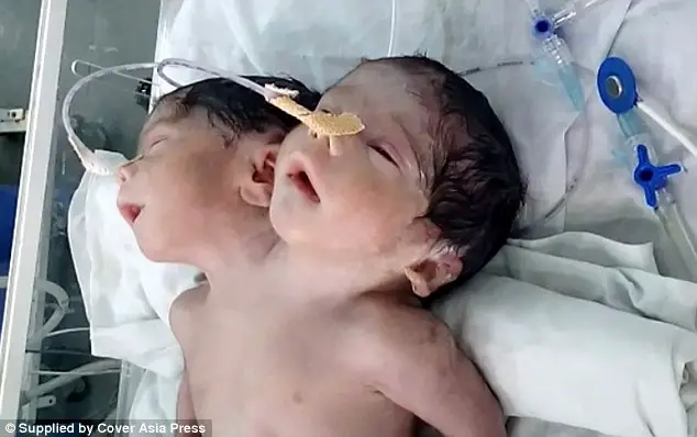two-headed baby