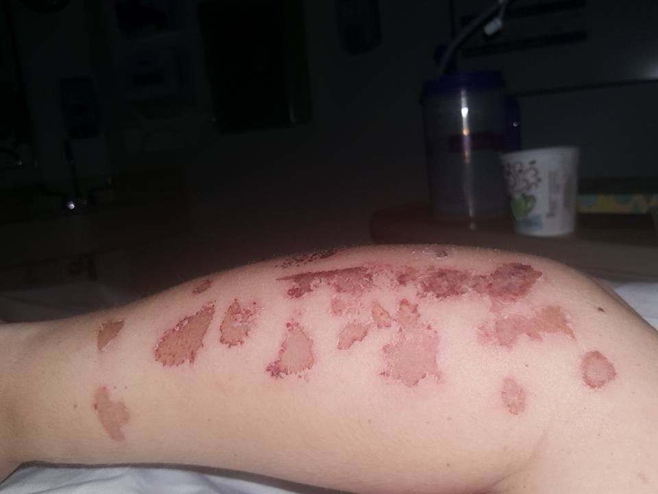 She Thought It Was Just A Rash, But Weeks Later Doctors Gave Her