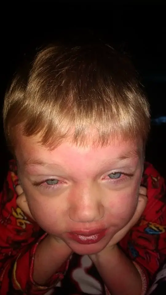 son with measles