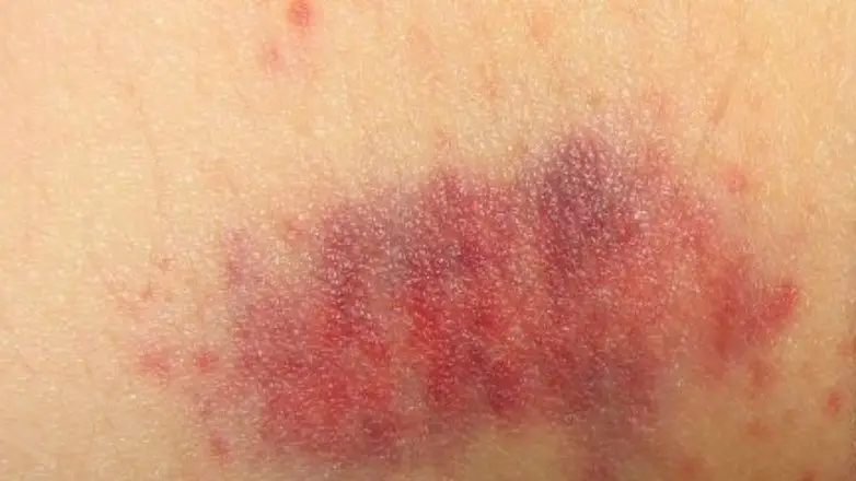 hickeys on teen