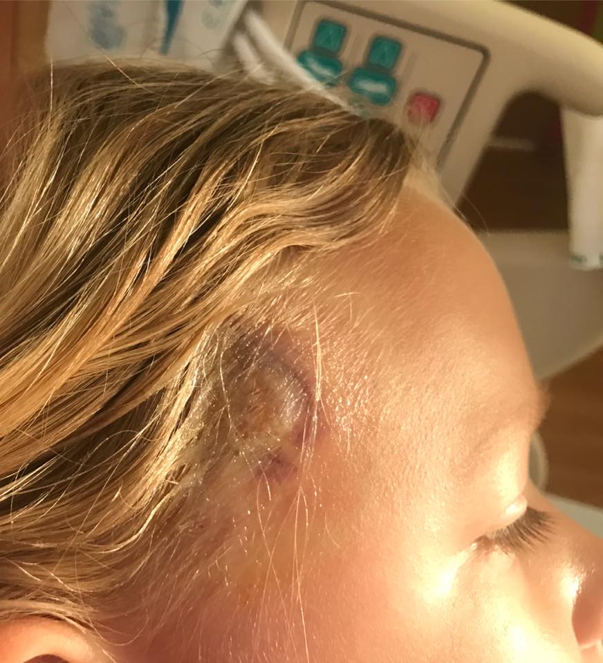 daughter with lyme disease