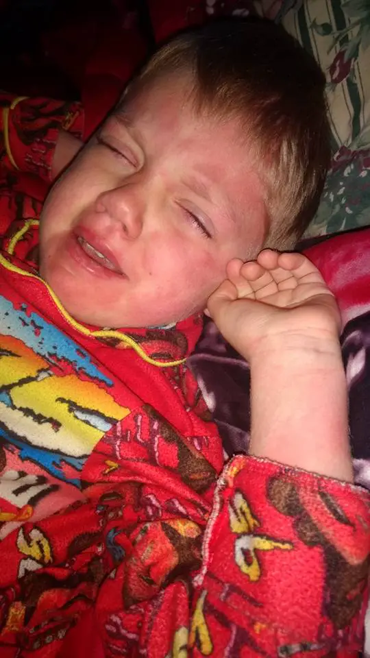 son with measles