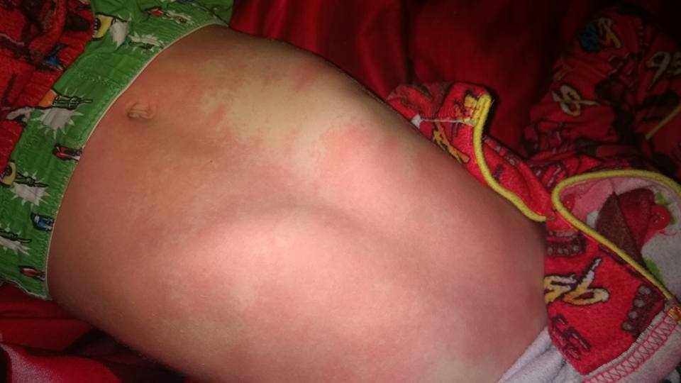son with measles