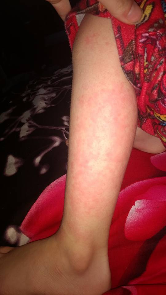 son with measles