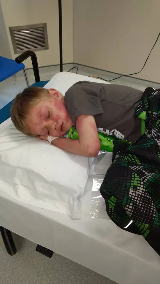 son with measles