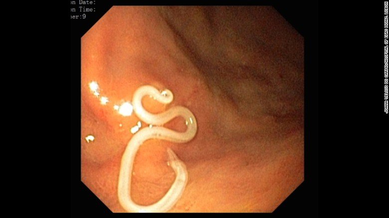 worm in stomach