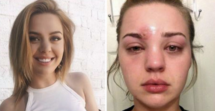 Staph infection of the eye
