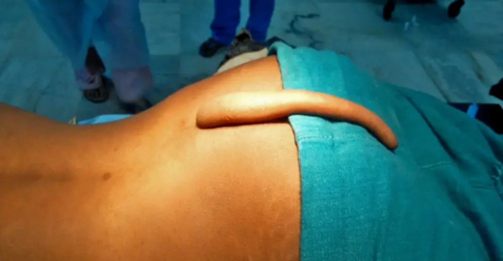Born With A Tail This Teen Was Told It Was A Good Luck Charm. Then He