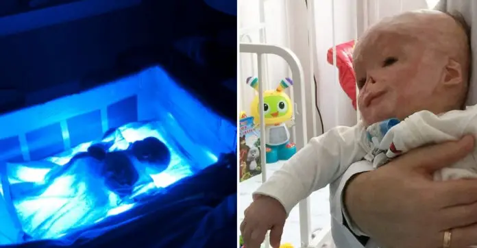 matvey-zakharenko-baby-burned