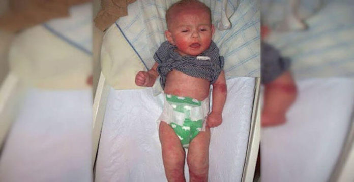 baby-isaiah-eczema