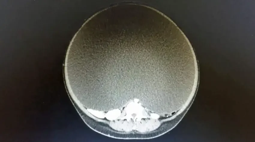 largest cyst