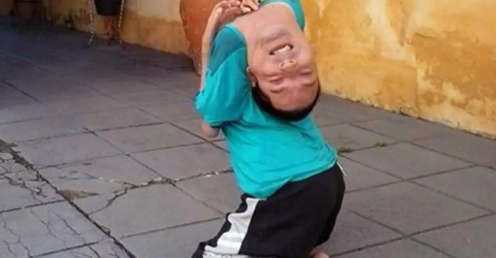 Man Born With An Upside Down Head, But His Story Will Leave You