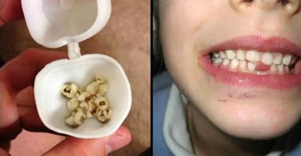 Comment Perdre Son Gland De Lait Doctors Are Now Warning Parents To Keep Their Children’s Milk Teeth