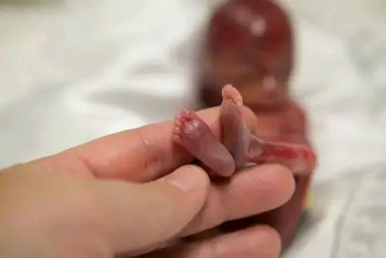 premature baby and mother