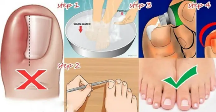 get-rid-of-ingrown-toe-nails