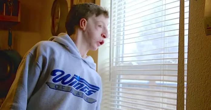teen-bullied-over-his-face