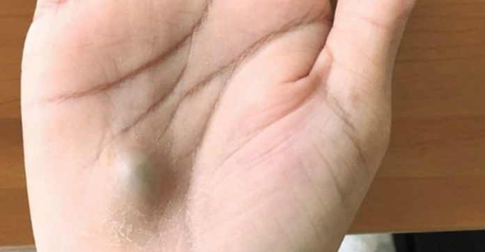 dentist-bumps-on-your-hand
