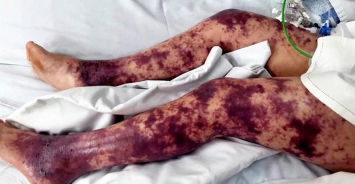 little-girls-bruises-getting-worse