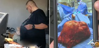 Hector Hernandez 77 pound tumor