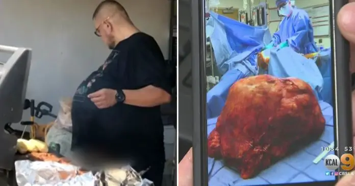 Hector Hernandez 77 pound tumor
