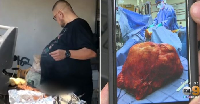 Hector-Hernandez-77-pound-tumor Hector Hernandez 77 pound tumor