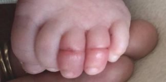 hair tourniquet syndrome baby toes