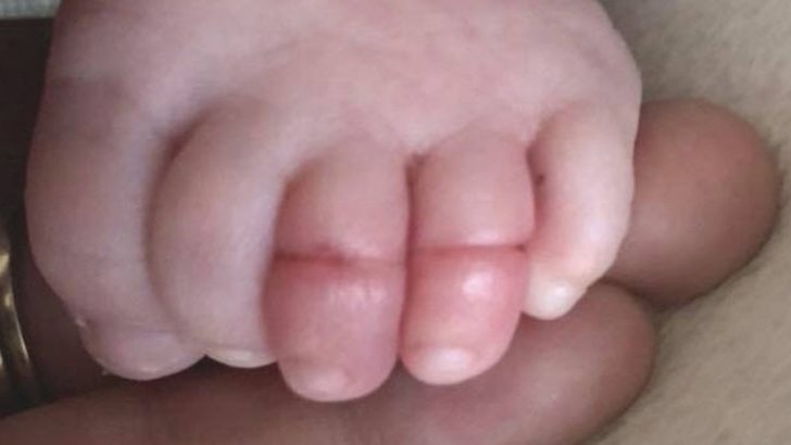 hair tourniquet syndrome baby toes