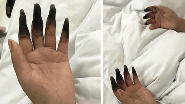 woman fingers black gangrene