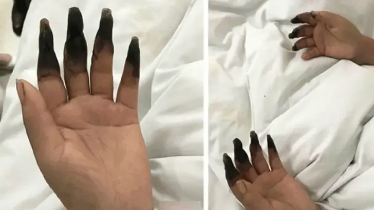 woman fingers black gangrene