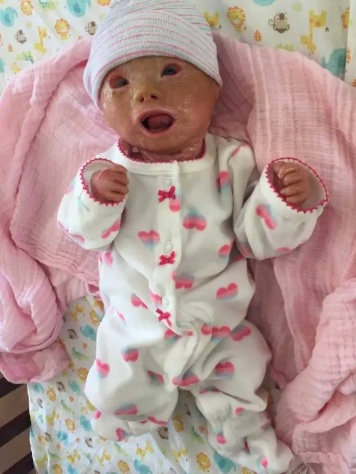 Harlequin Ichthyosis Causes Newborn’s Skin To Dry And Crack