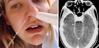 woman dies after using neti pot