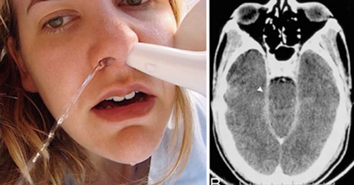 woman-dies-after-using-neti-pot woman dies after using neti pot