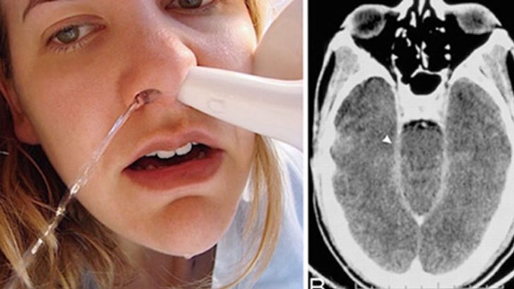 woman dies after using neti pot