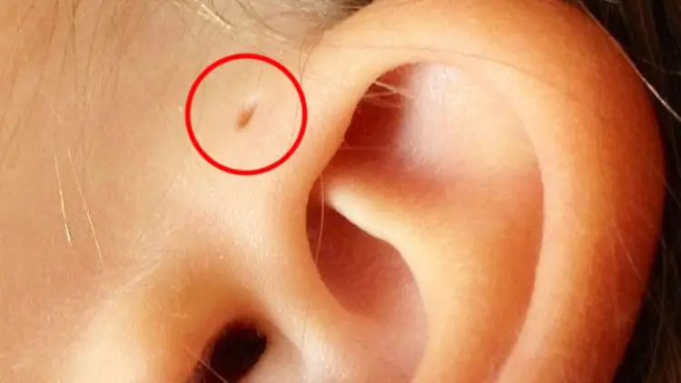 hole above your ear