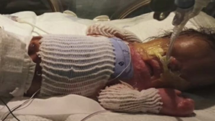 baby born without skin