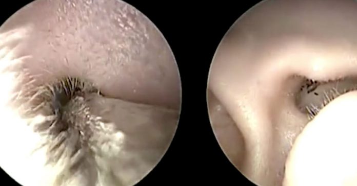 doctors-yank-out-tick-from-ear