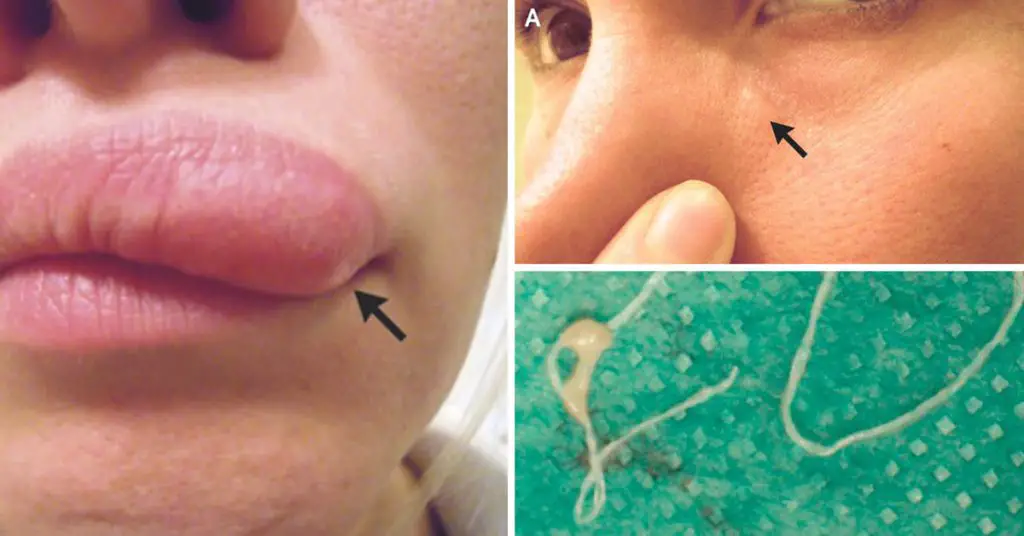 Itchy Lump On Womans Face Turns Out To Be A 6 Inch Worm