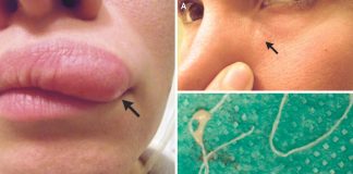 Itchy Lump On Woman Face