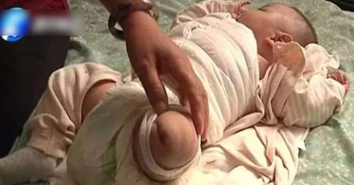 newborn baby amputate leg newborn baby amputate leg