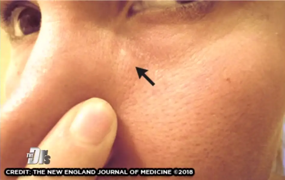 Itchy Lump On Woman Face