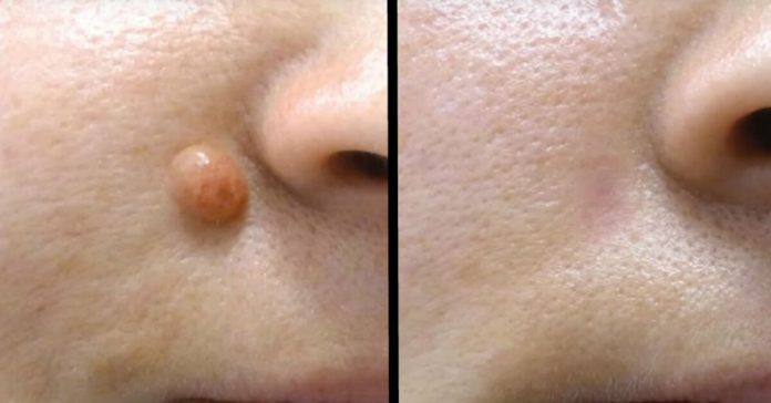 remove-skin-tags-and-moles