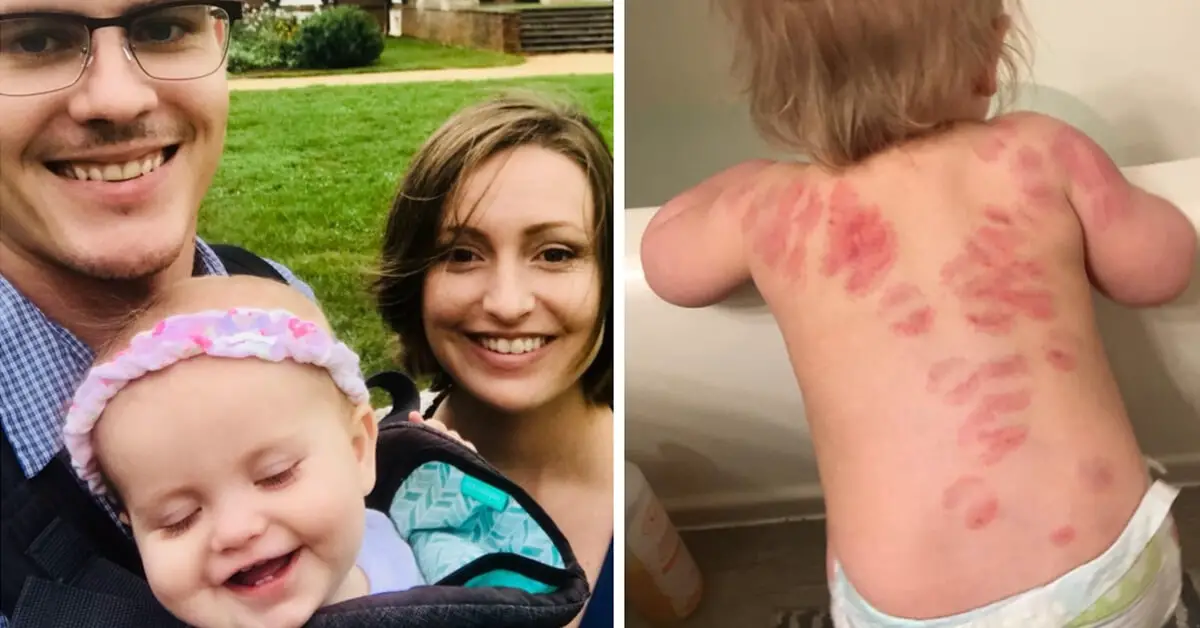 Mom Finds 25 Bite Marks On Her 15MonthOld Daughter