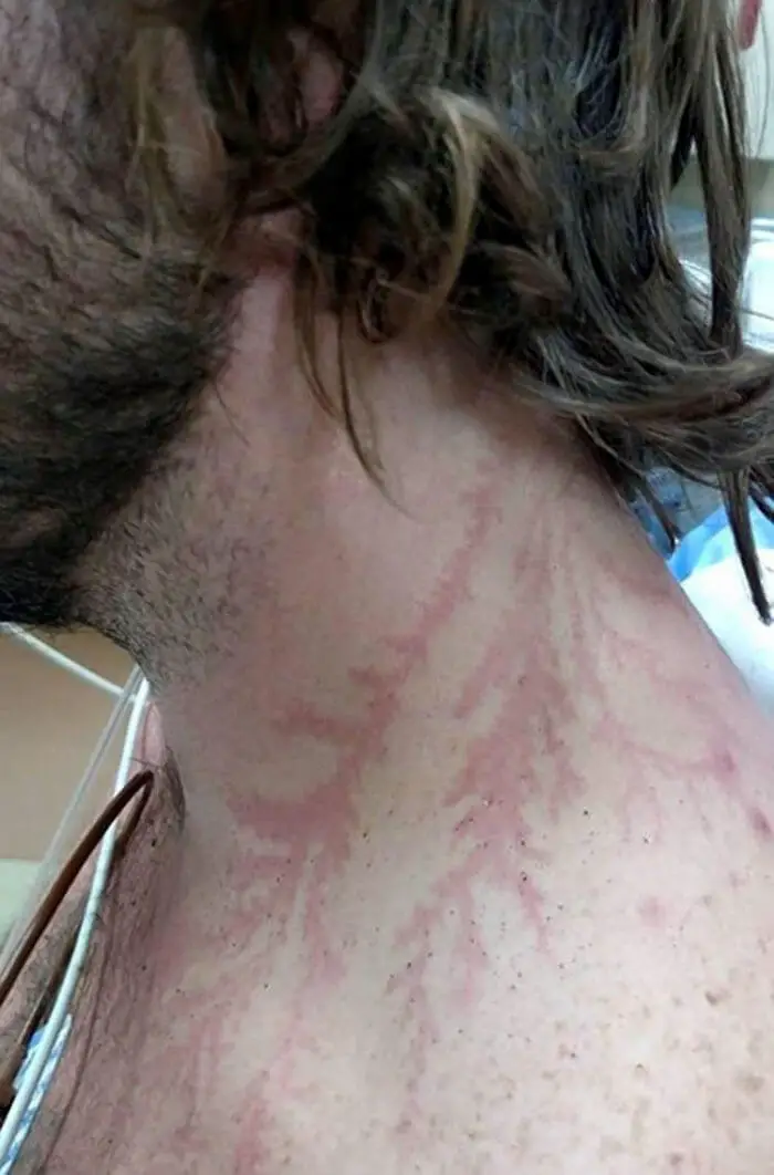 lightning scars name lightning scars name