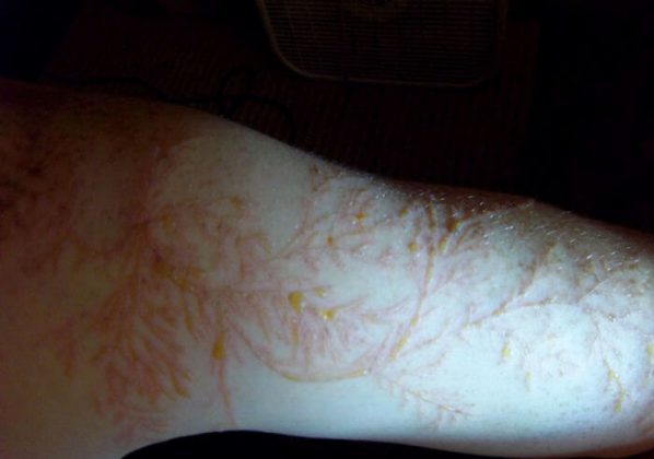 lightning strike scars lightning strike scars
